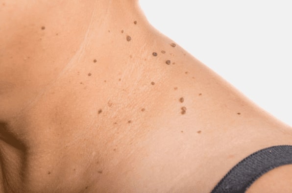 Are you looking for easy skin tag removal Malvern Wells - then contact Spire today!