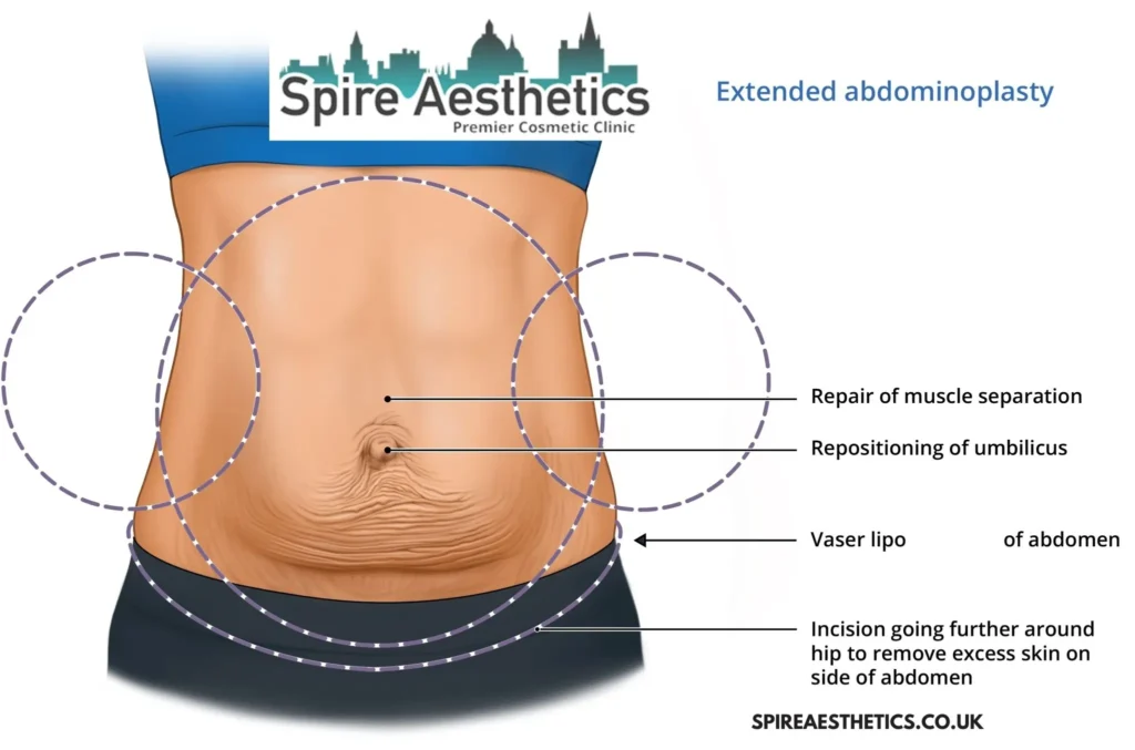 Understanding Loose Skin After Gastric Band Malvern Wells Surgery and HIFU Treatment