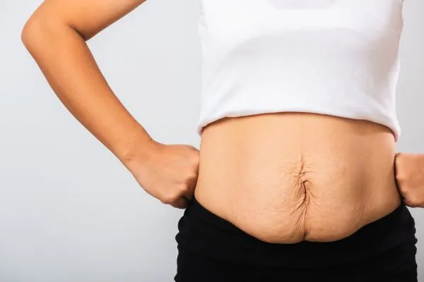 Image of a woman's stomach after weight loss with sagging skin following a gastric band Malvern Wells