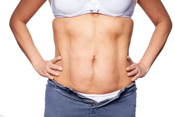 sagging skin on woman's stomach after weight loss injections Malvern Wells